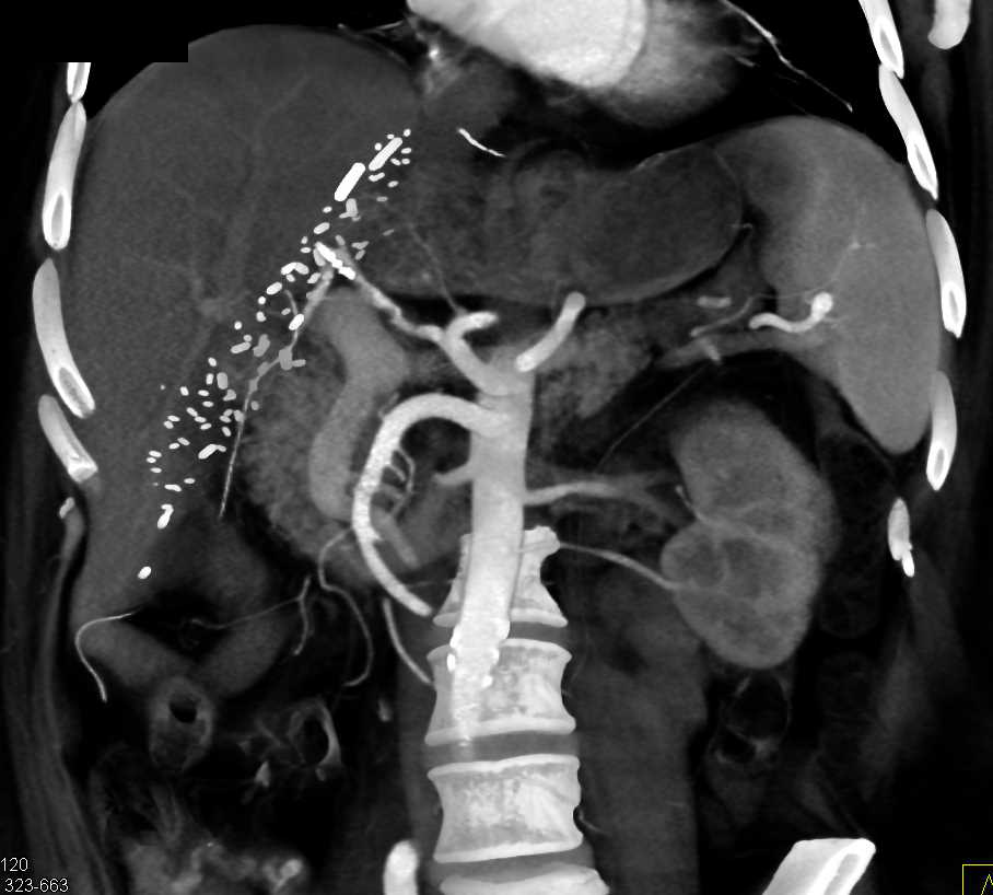 Narrowing of Hepatic Artery Anastomosis in Liver Transplant Patient - CTisus CT Scan