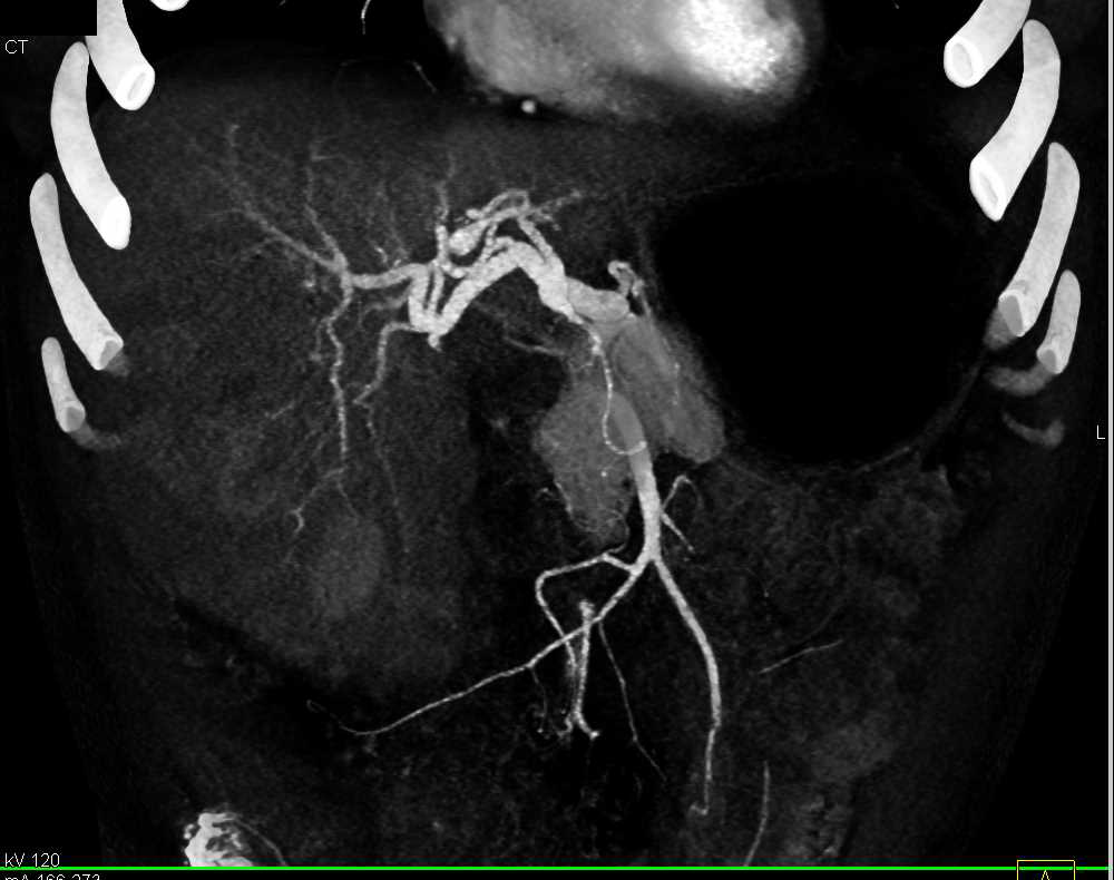 Hepatocellular Carcinoma (Hepatoma) with Neovascularity in the Liver - CTisus CT Scan