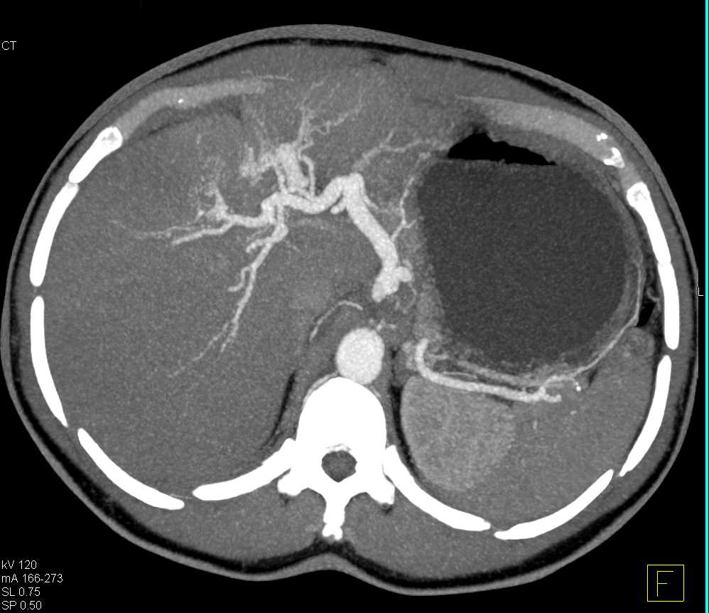 Hepatocellular Carcinoma (Hepatoma) in a Cirrhotic Liver - CTisus CT Scan