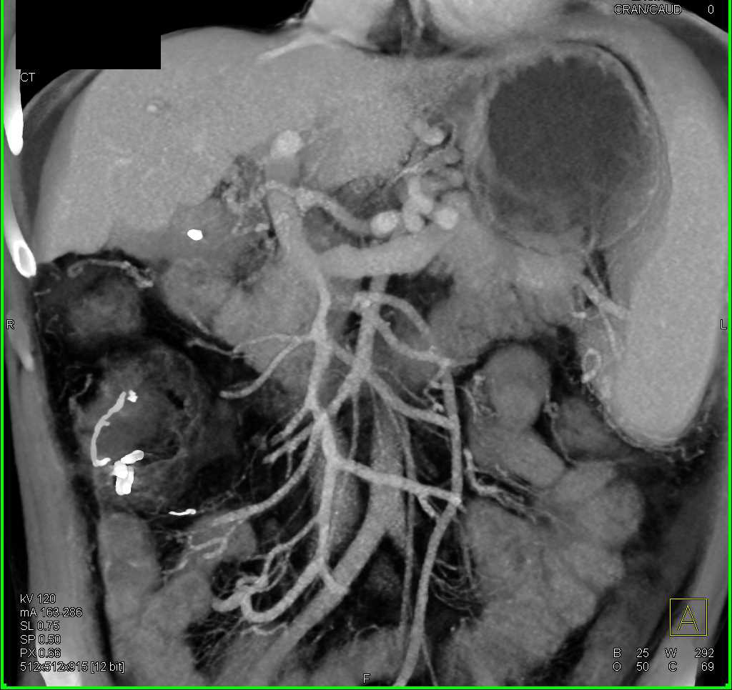 Cirrhosis with Clot in the Portal Vein - CTisus CT Scan