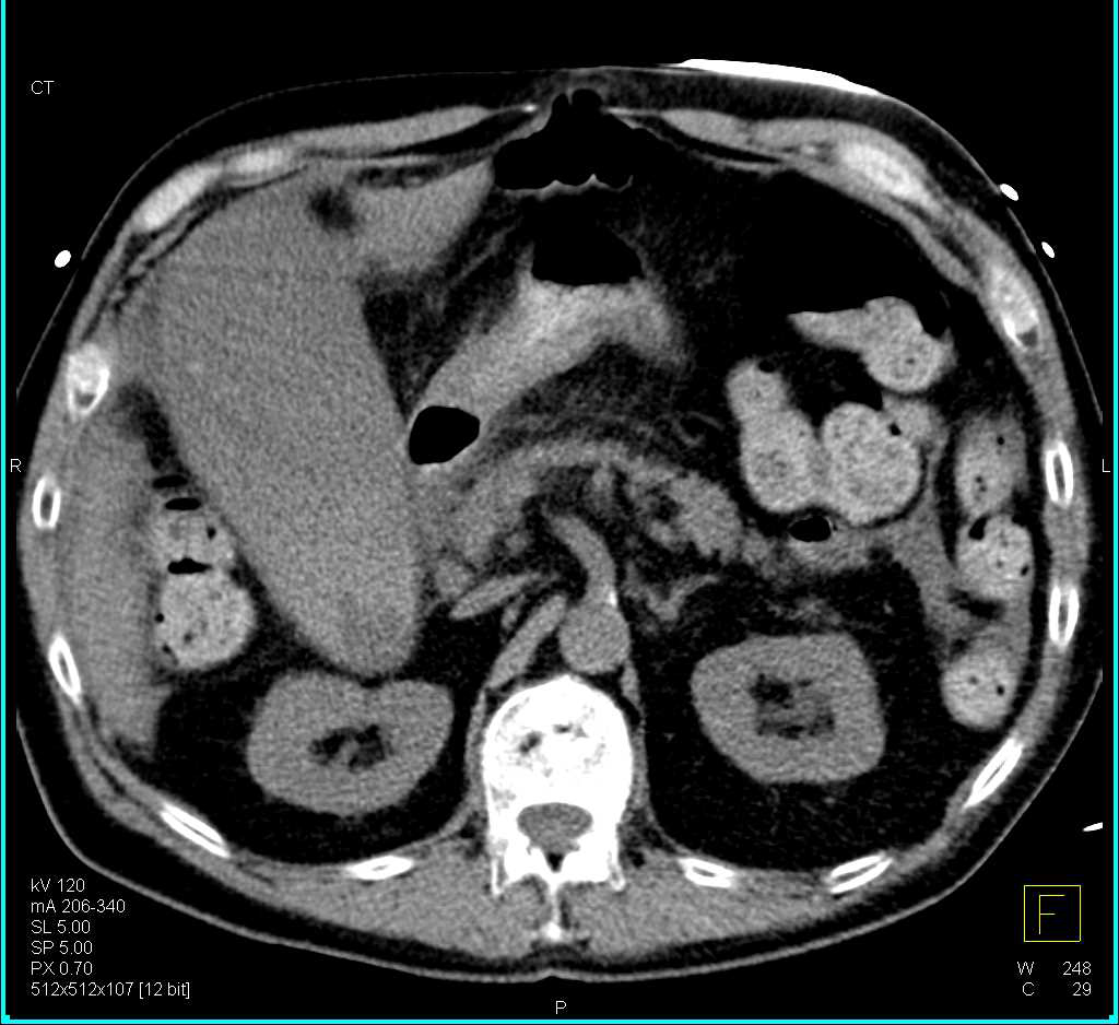 Unusual Case with Active Bleeding into the Gallbladder - CTisus CT Scan