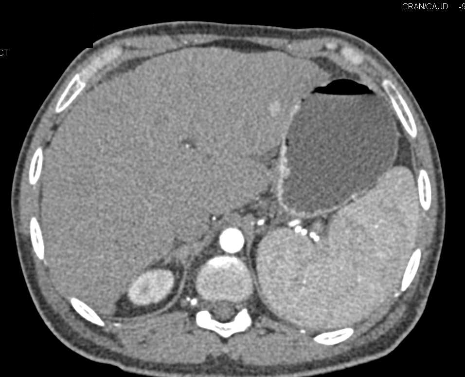 Nodular Changes in the Liver Compatible with Cirrhosis - CTisus CT Scan