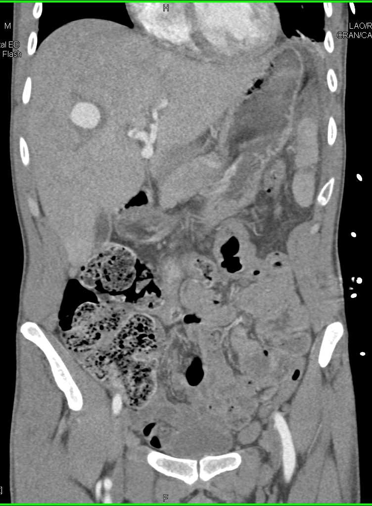 Hepatic Artery Pseudoaneurysm and Splenic Infarction - CTisus CT Scan