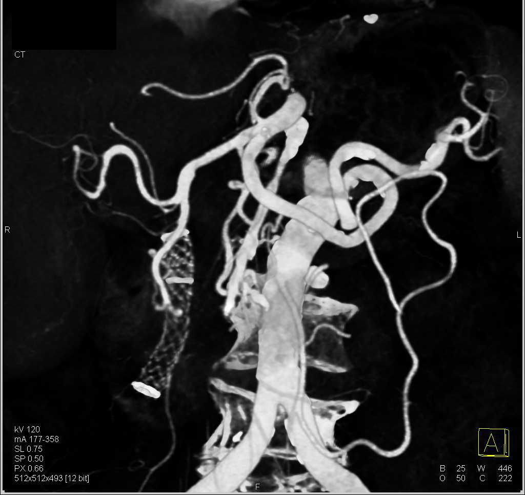 Wall Stent in Common Bile Duct - CTisus CT Scan