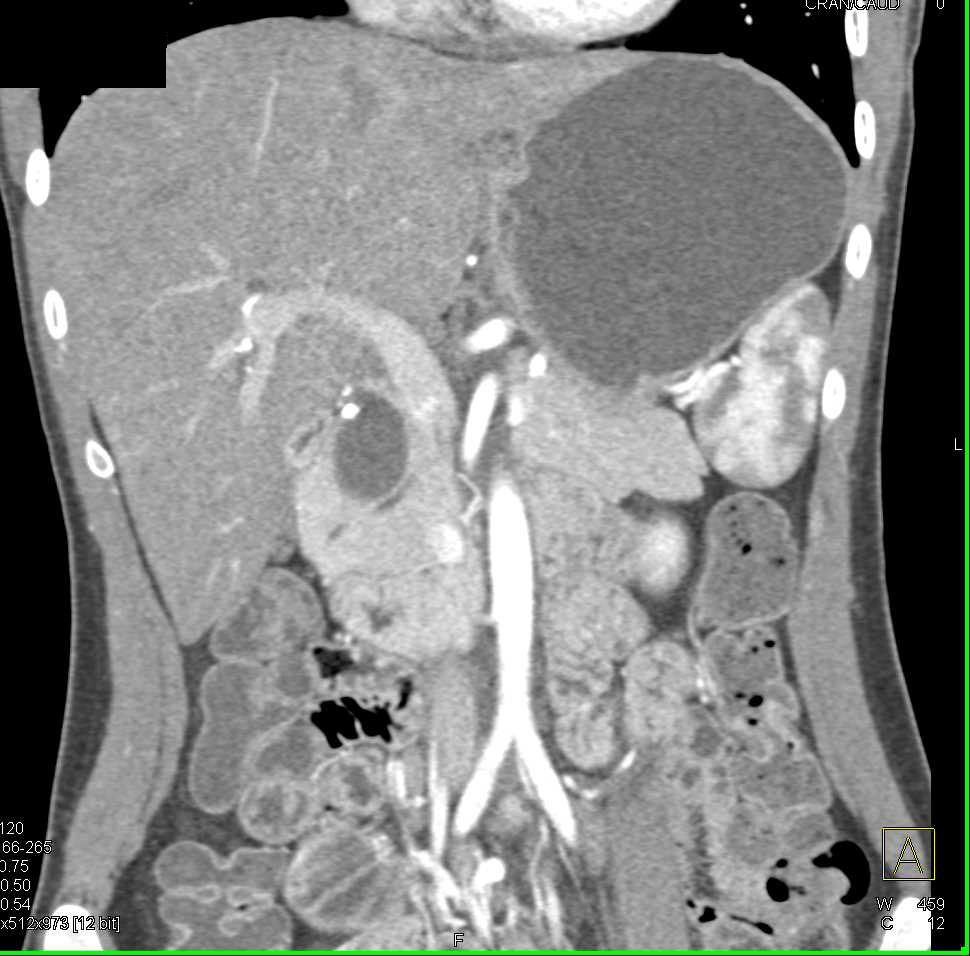 Choledochal Cyst - CTisus CT Scan