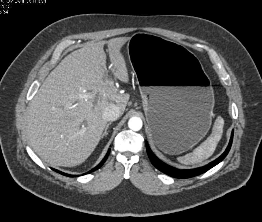 Cholangiocarcinoma with Left Ductal Dilatation and Atrophy of Left Lobe - CTisus CT Scan