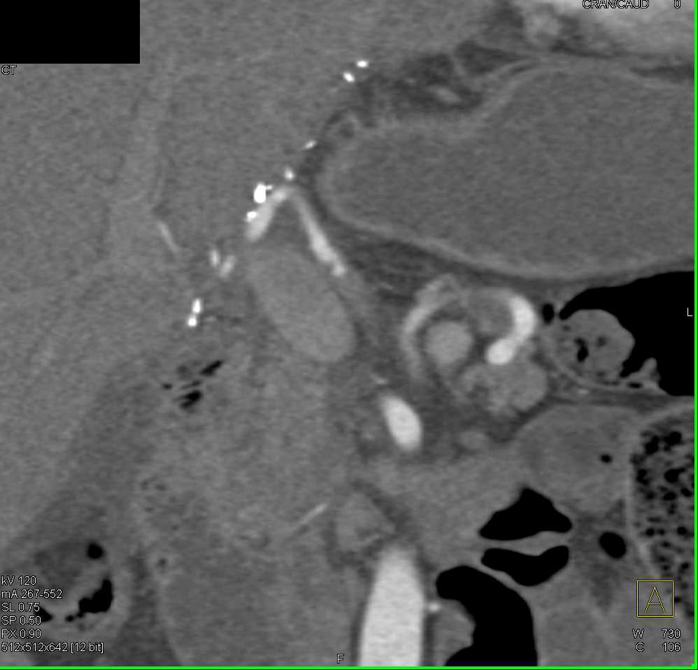 Hepatic Artery Stenosis in a Liver Transplant Patient - CTisus CT Scan