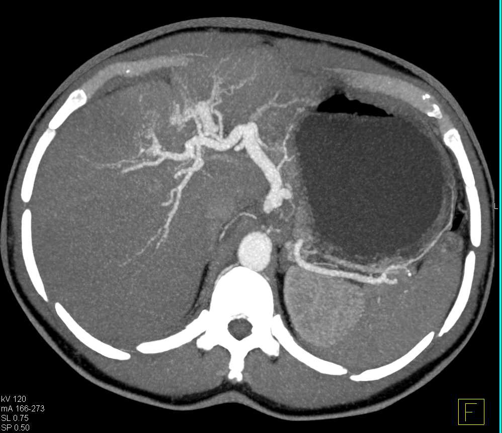 Multifocal Cholangiocarcinoma - CTisus CT Scan