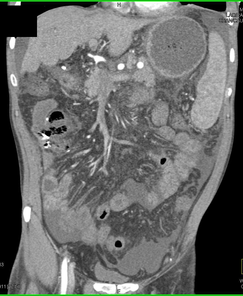 Cirrhosis with Clot in the Portal Vein and Superior Mesenteric Vein (SMV) - CTisus CT Scan