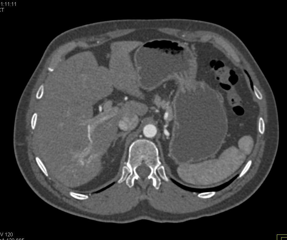 Perfusion Changes in the Right Lobe of the Liver - CTisus CT Scan