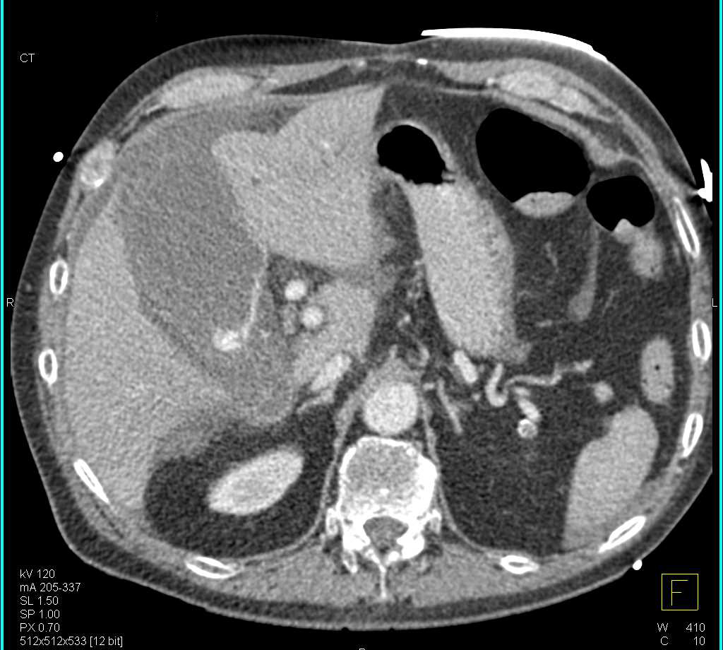 Active Hemorrhage In the Gallbladder - CTisus CT Scan