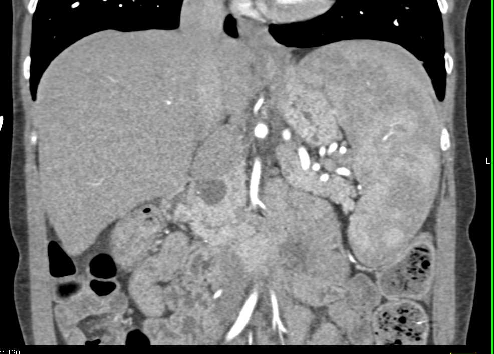 Ampullary Stricture due to Carcinoma at Ampulla - CTisus CT Scan