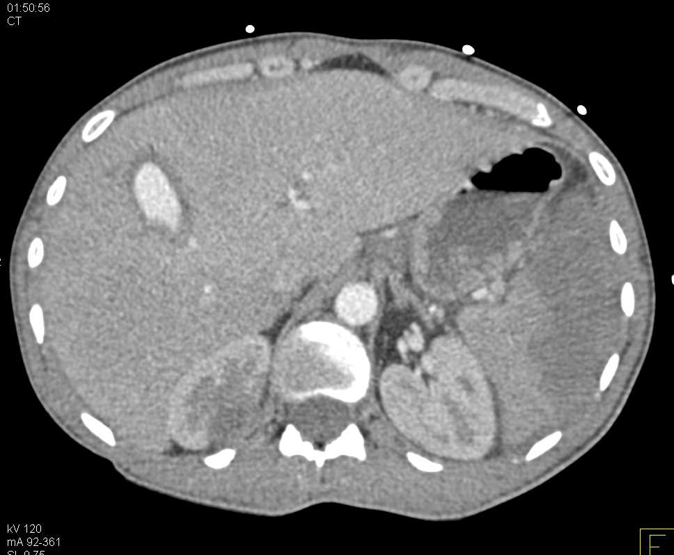 Hepatic Artery Pseudoaneurysm - CTisus CT Scan
