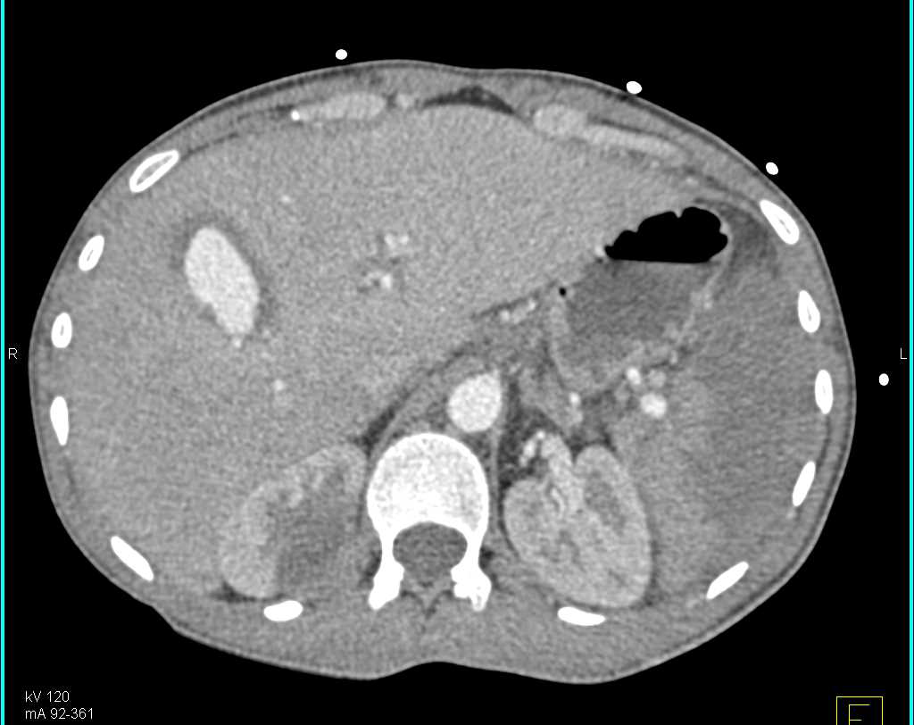 Hepatic Artery Pseudoaneurysm - CTisus CT Scan