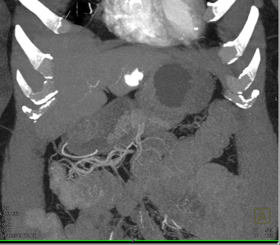 Gastric Lipoma and Calcified Hemangioma in Left Lobe of the Liver - CTisus CT Scan