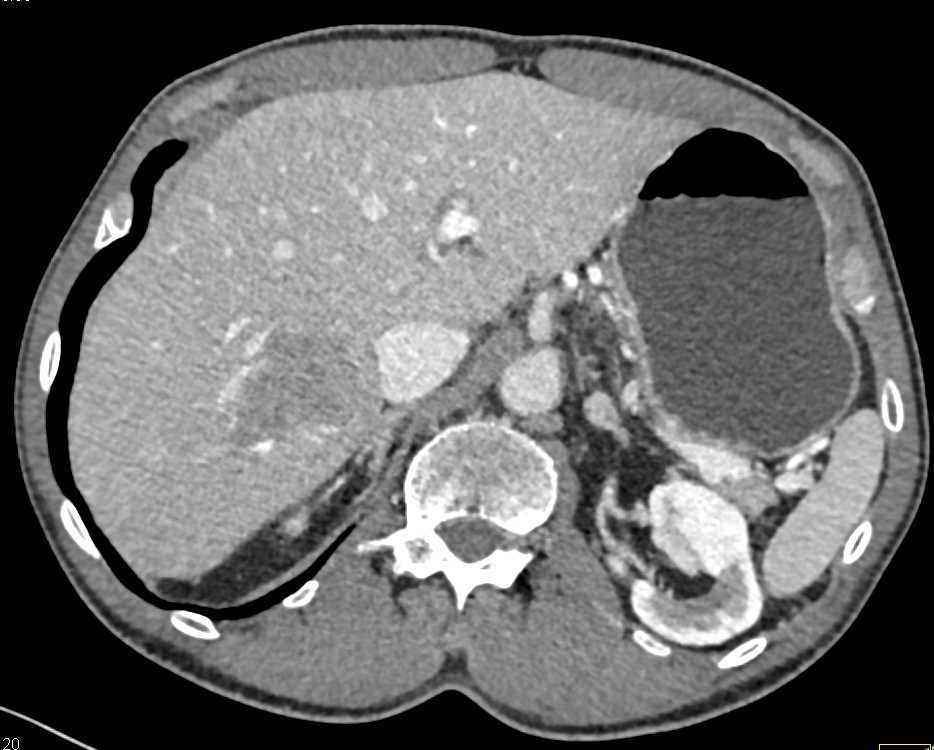 Hepatocellular Carcinoma (Hepatoma) on Multiphasic Imaging - CTisus CT Scan