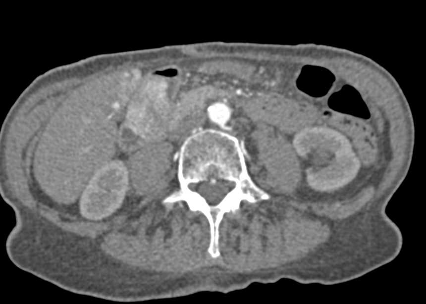 Arteriovenous (AV) Shunt in Right Lobe of the Liver - CTisus CT Scan