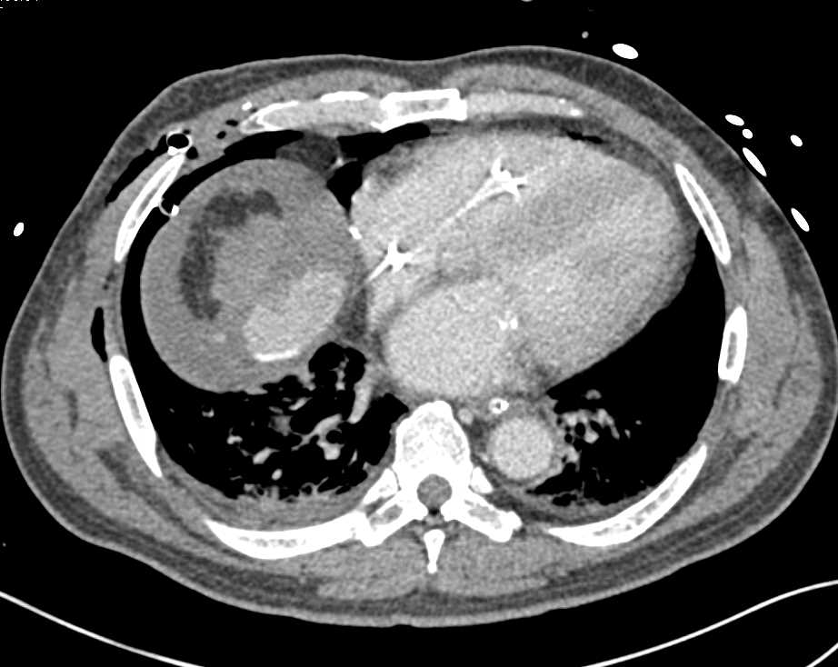 Hemoperitoneum with Underlying Cirrhosis - CTisus CT Scan