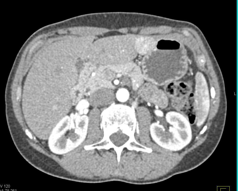 Focal Nodular Hyperplasia in Left Lobe - CTisus CT Scan