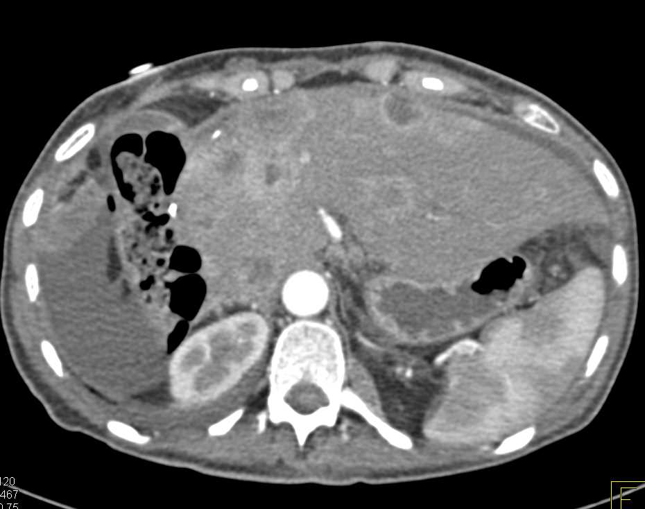 Recurrent Cholangiocarcinoma to Liver and Omentum - CTisus CT Scan