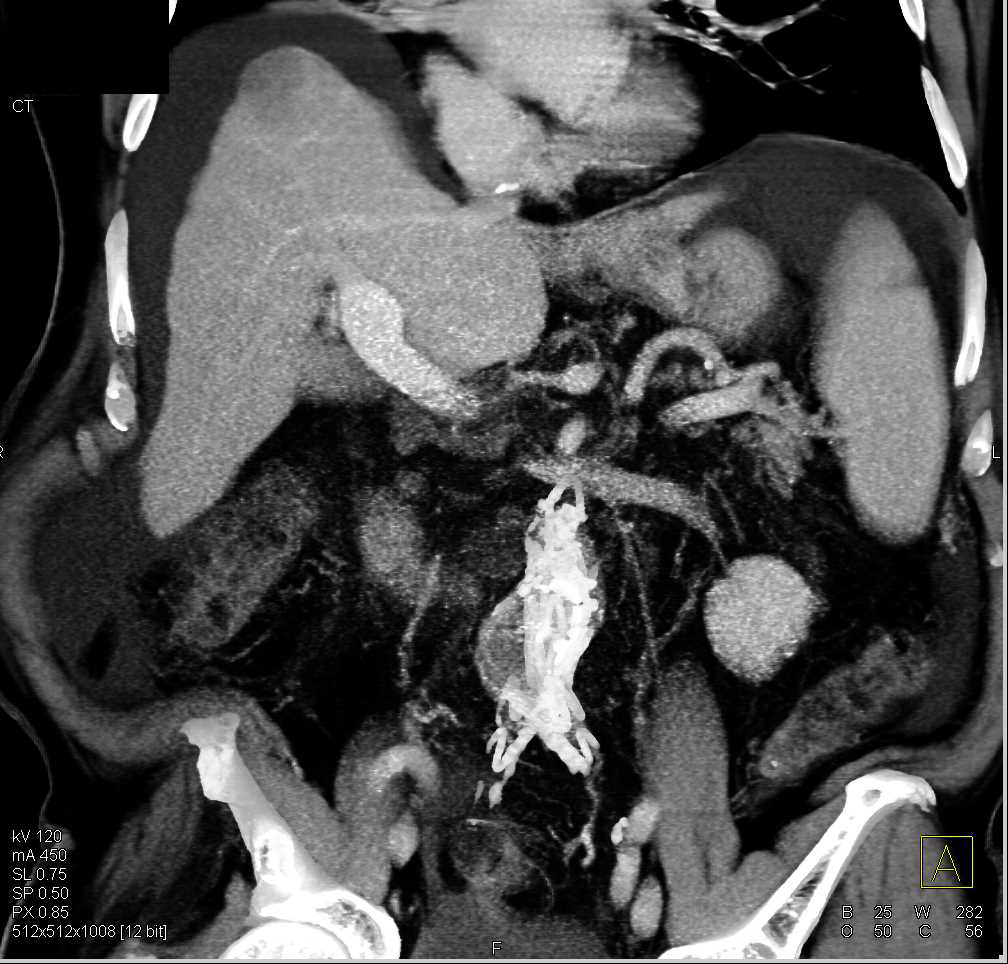 Hepatocellular Carcinoma (Hepatoma) in a Cirrhotic Liver - CTisus CT Scan