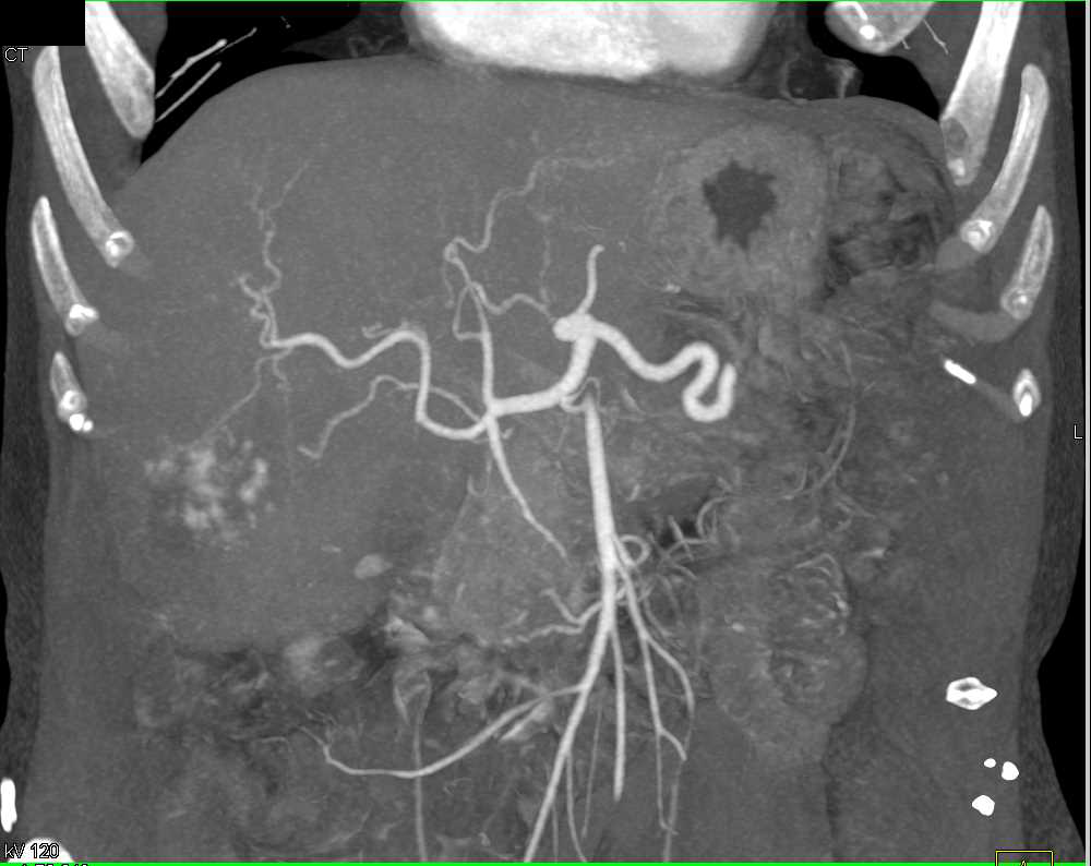 Hepatic Hemangioma - CTisus CT Scan