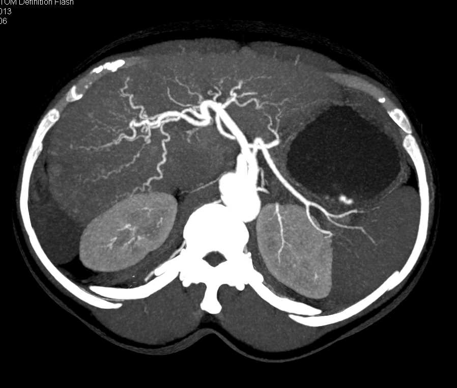 Cirrhosis of the Liver with Hepatic Congestion - CTisus CT Scan