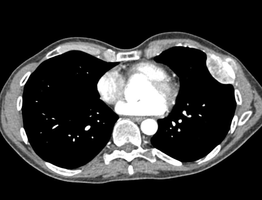 Neuroendocrine Tumor with Vascular Liver and Bone Metastases - CTisus CT Scan