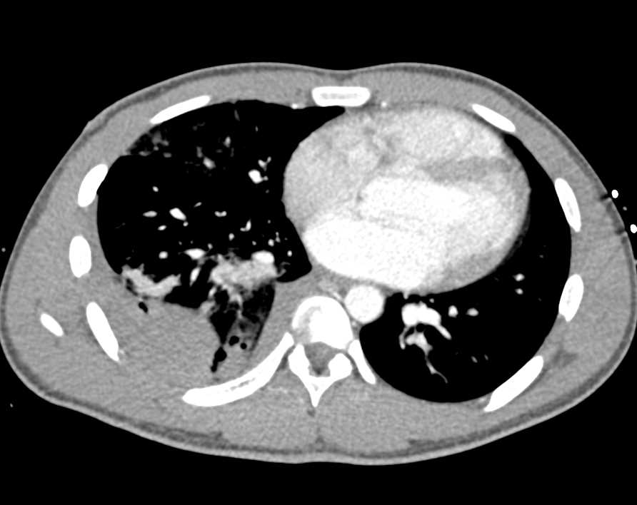 Liver Hematoma S/P Gunshot Wound - CTisus CT Scan