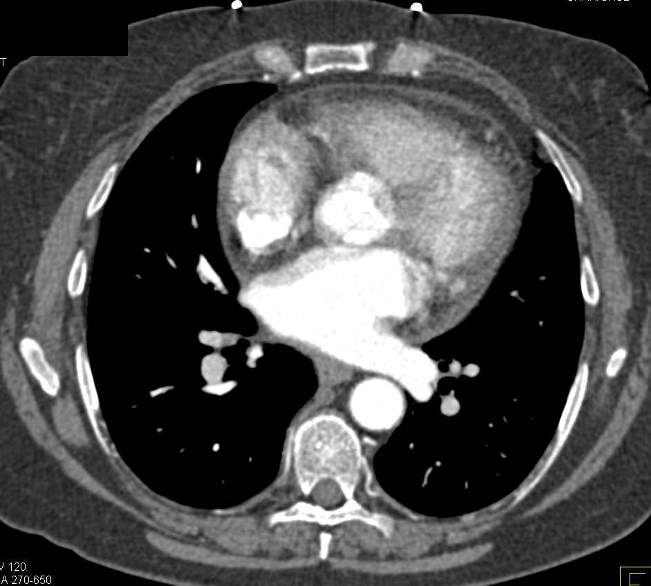 Hepatocellular Carcinoma (Hepatoma) in a Cirrhotic Liver - CTisus CT Scan