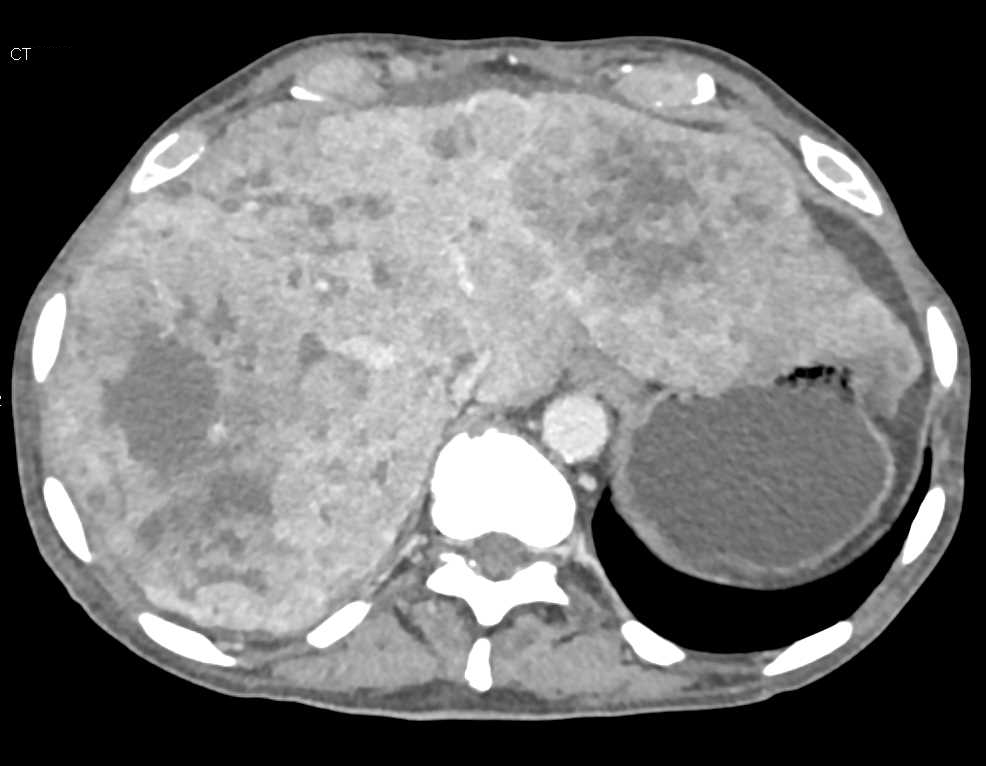 Metastatic Neuroendocrine Tumor to the Liver with Dual Phase Scanning - CTisus CT Scan