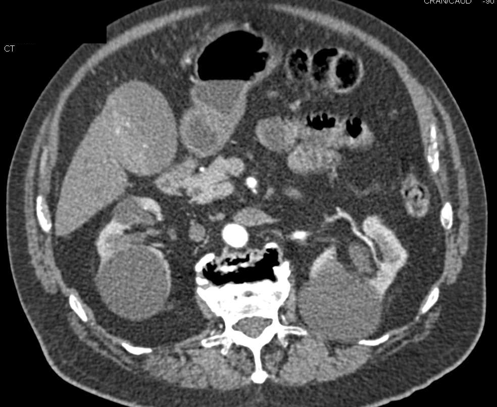 Gallbladder Cancer - CTisus CT Scan