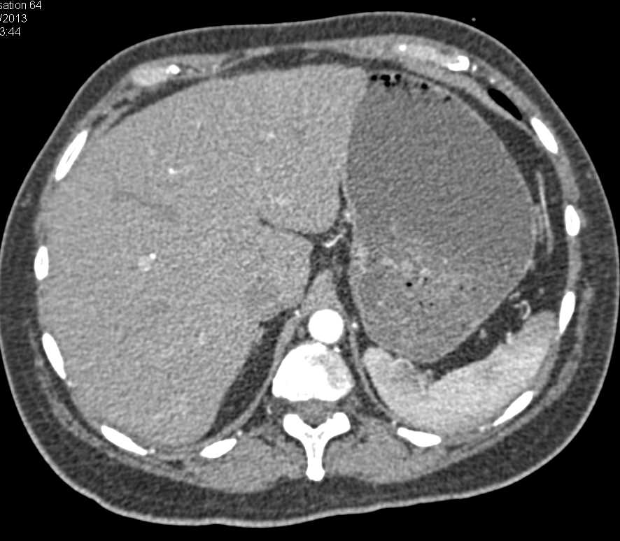 Hyopodense Liver Metastases - CTisus CT Scan