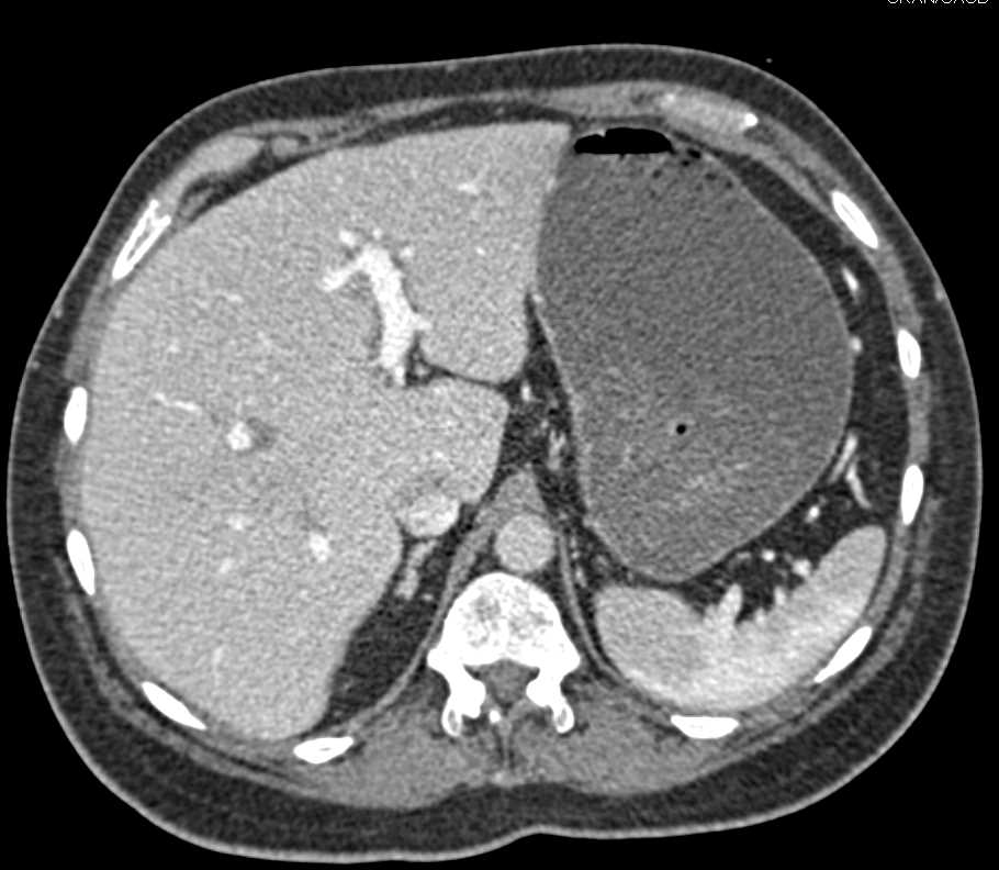 Hyopodense Liver Metastases Best Seen on Venous Phase Images - CTisus CT Scan