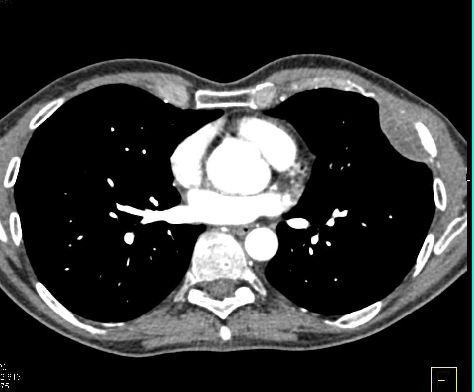 Metastatic Neuroendocrine Tumor to Liver and Bone - CTisus CT Scan