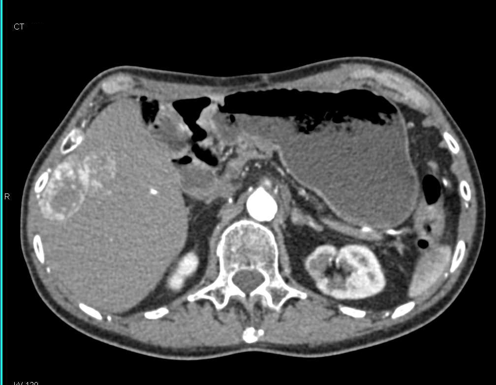 Metastatic Neuroendocrine Tumor of the Pancreas to Liver - CTisus CT Scan