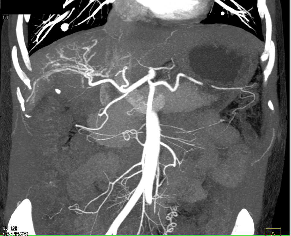 Hepatocellular Carcinoma (Hepatoma) Arising in a Cirrhotic Liver - CTisus CT Scan