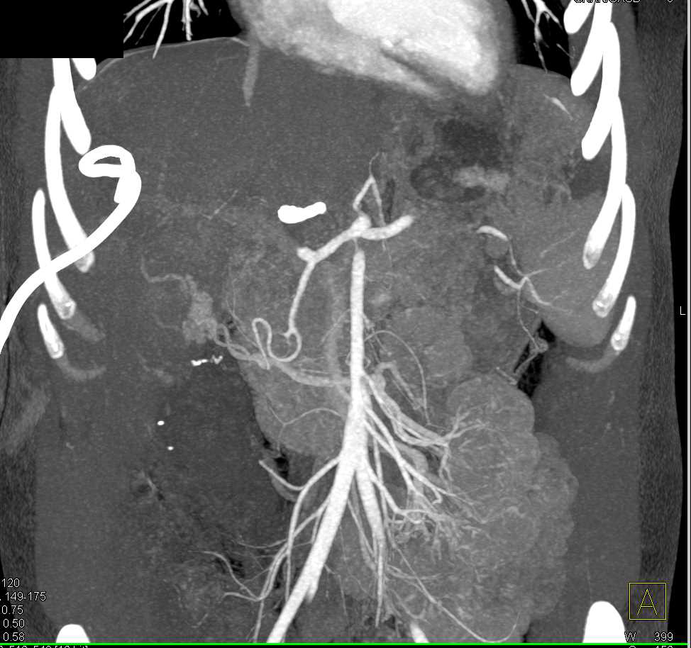 Liver and Splenic Infarcts - CTisus CT Scan