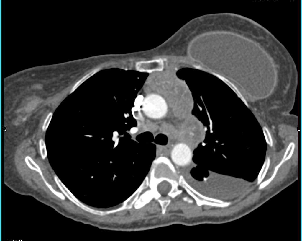 Lymphoma with Splenic and Hepatic Involvement - CTisus CT Scan