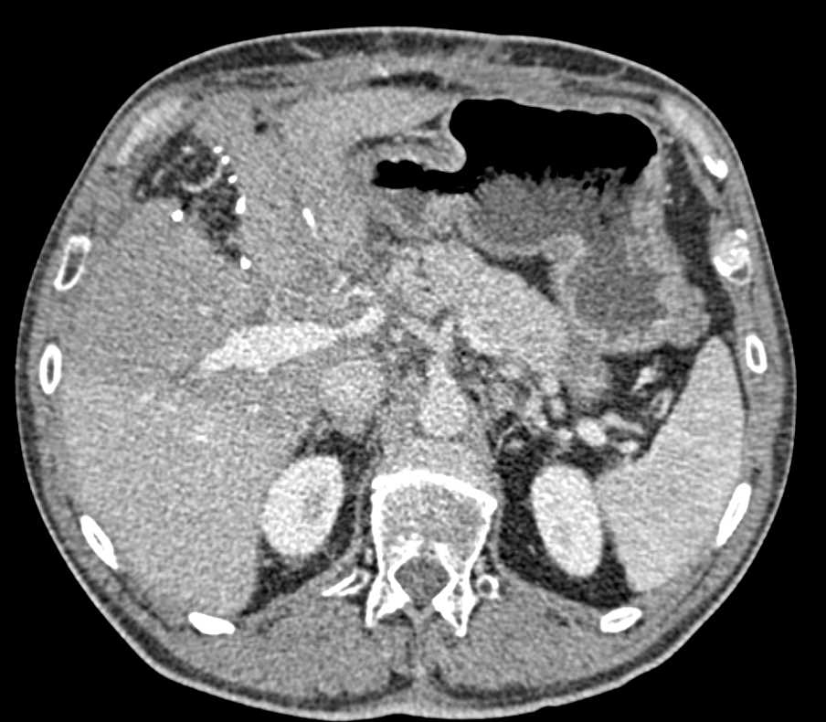 Radiation Changes in Liver with Radiation Ports Noted and Radiation Hepatitis - CTisus CT Scan