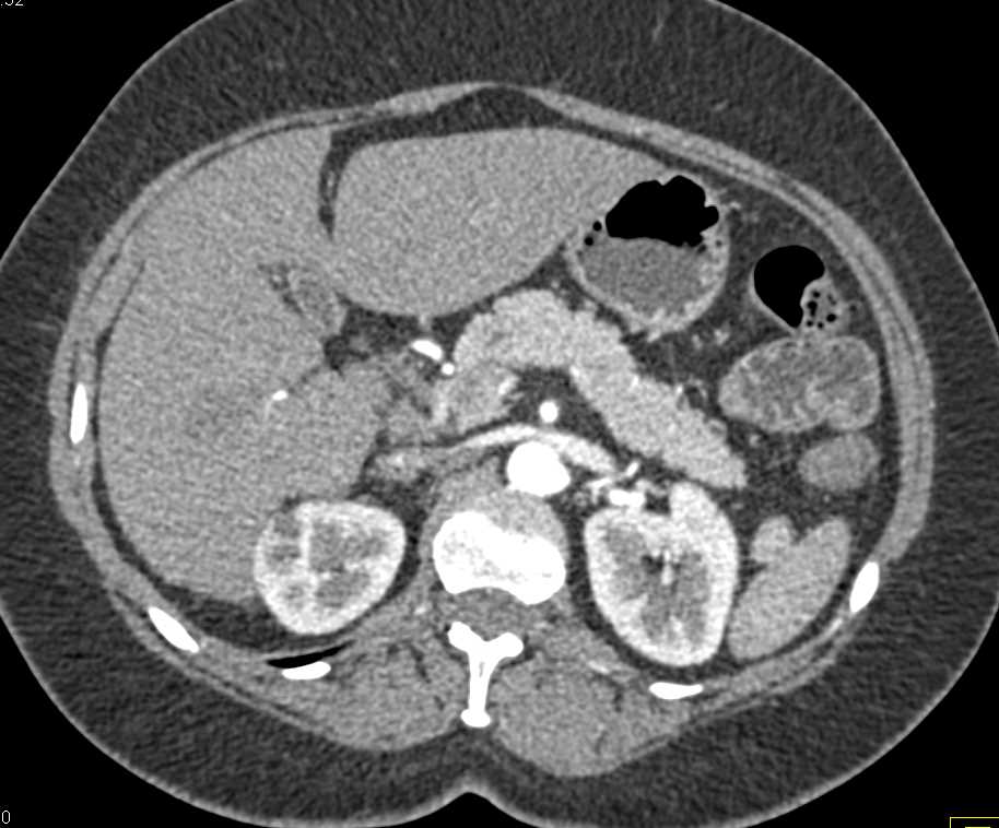 Liver Metastases Missed on Arterial Phase Imaging-Typical for Colon Cancer - CTisus CT Scan