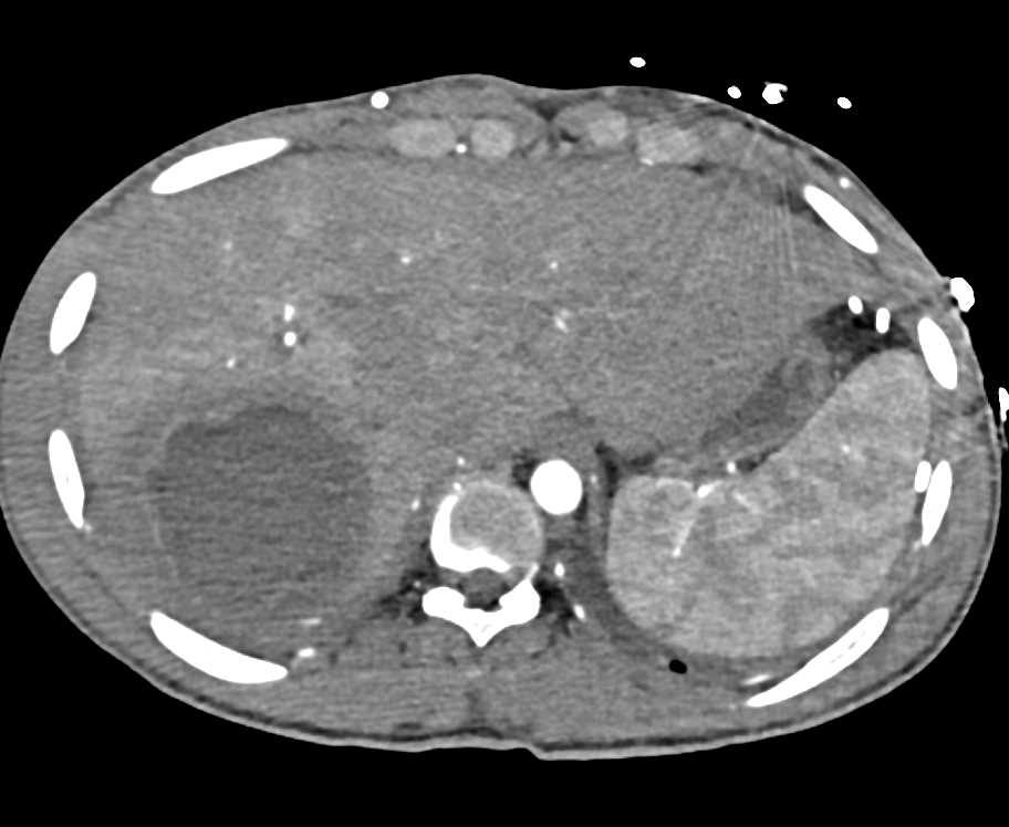 Liver Abscess - CTisus CT Scan