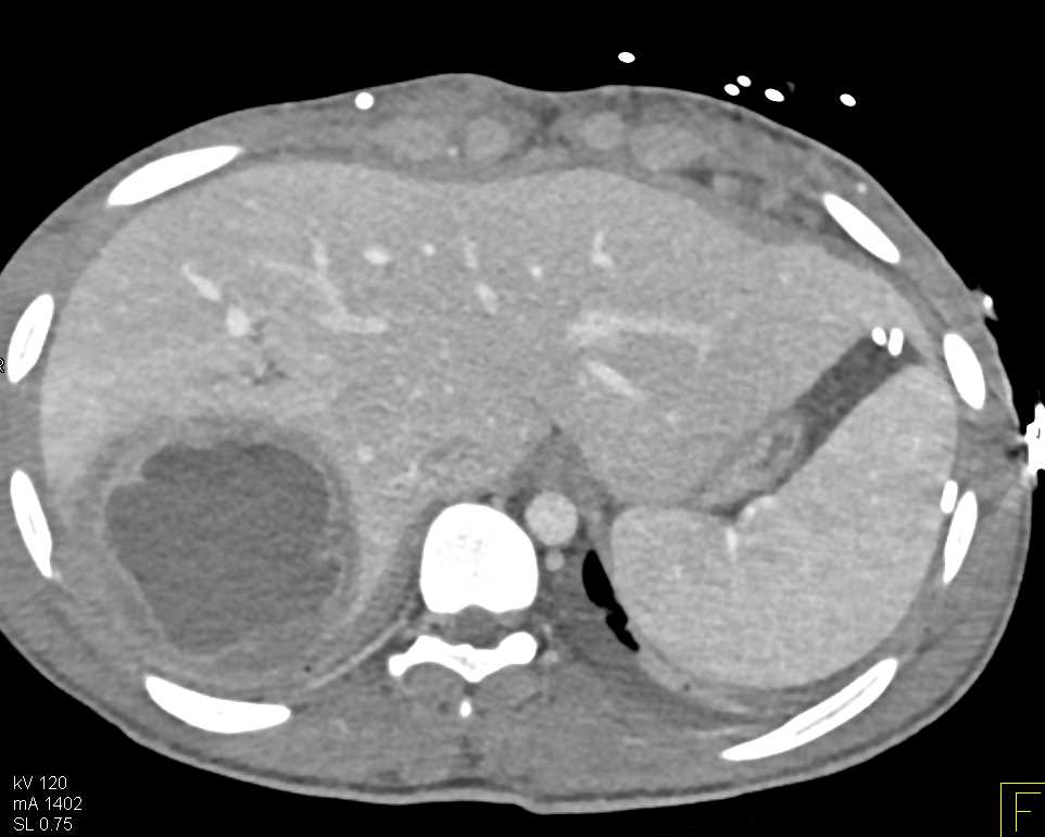 Liver Abscess - Liver Case Studies - CTisus CT Scanning