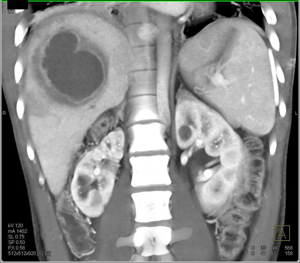 Liver Abscess - CTisus CT Scan