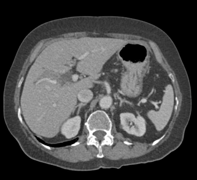 Stone in Common Bile Duct with Cholangitis - CTisus CT Scan