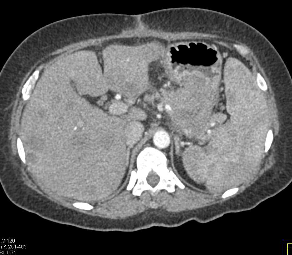 Gastric Adenocarcinoma with Liver Metastases - CTisus CT Scan