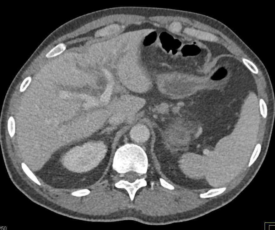 Infiltrating Cholangiocarcinoma - CTisus CT Scan