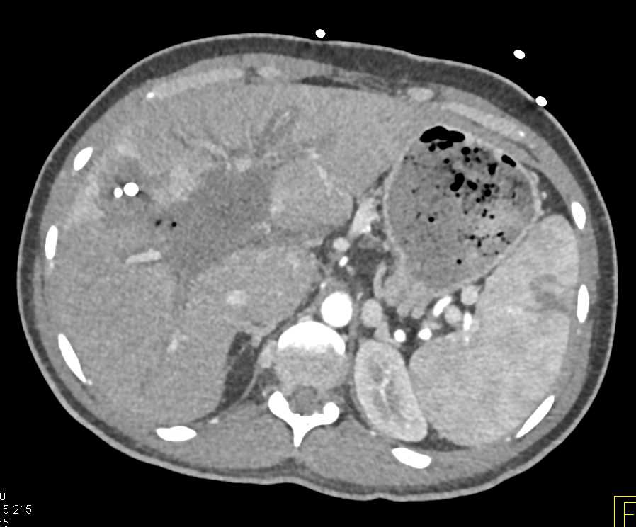 Cholangiocarcinoma with Biloma Following Stent Placement - CTisus CT Scan