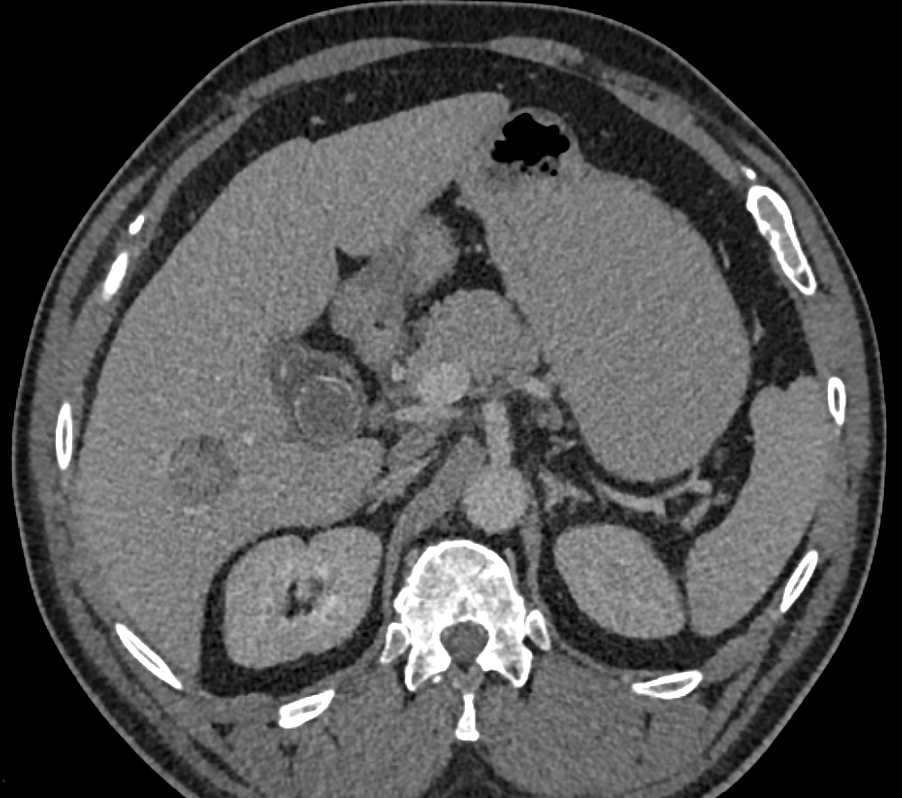 2 cm Hepatocellular Carcinoma (Hepatoma) in a Cirrhosis of the Liiver - CTisus CT Scan