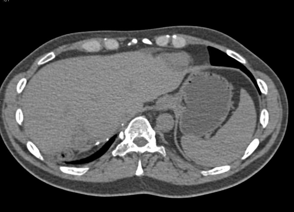 Recurrent Neuroendocrine Tumor in the Liver - CTisus CT Scan